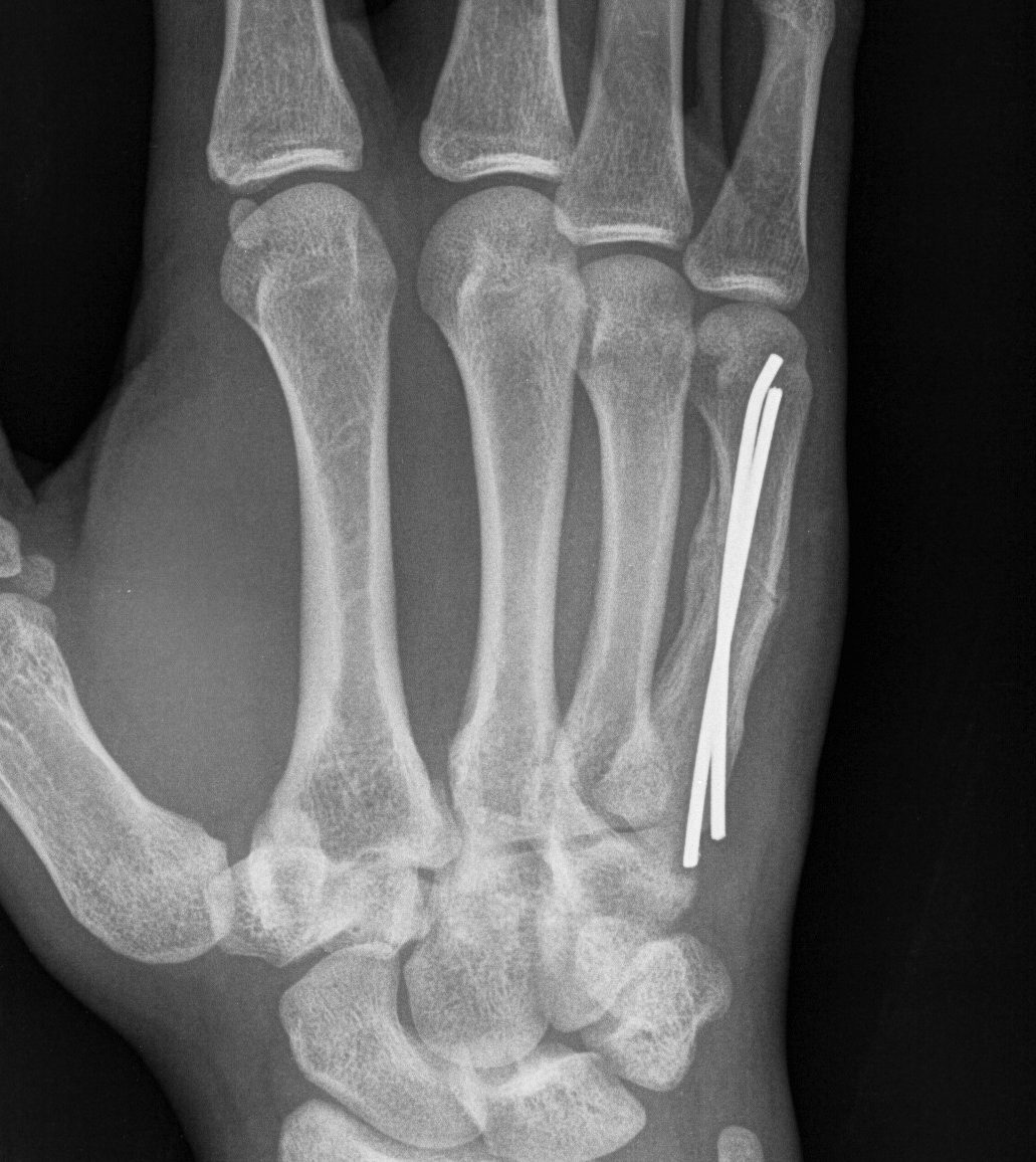 Metacarpal Intramedullary Wires